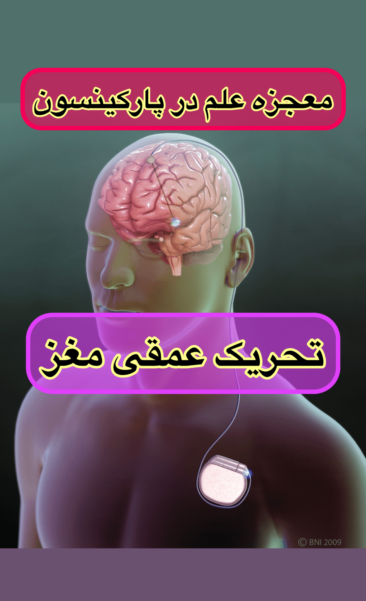 تحریک عمقی مغز (DBS) در درمان پارکینسون