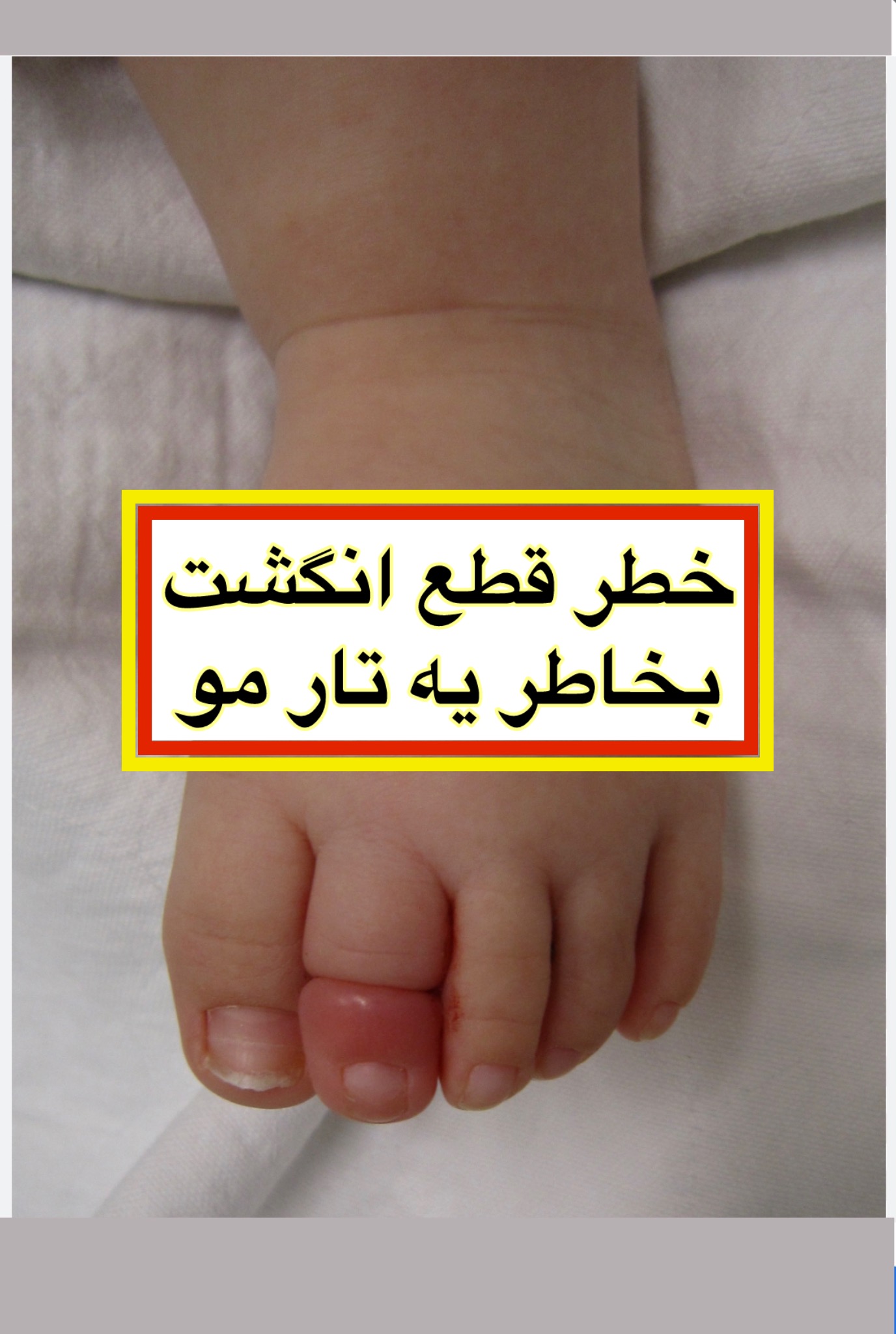 قطع انگشت نوزاد بخاطر یک تار مو