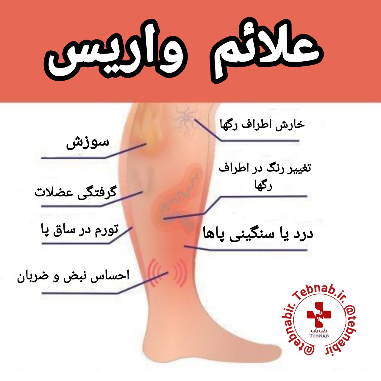 علائم واریس